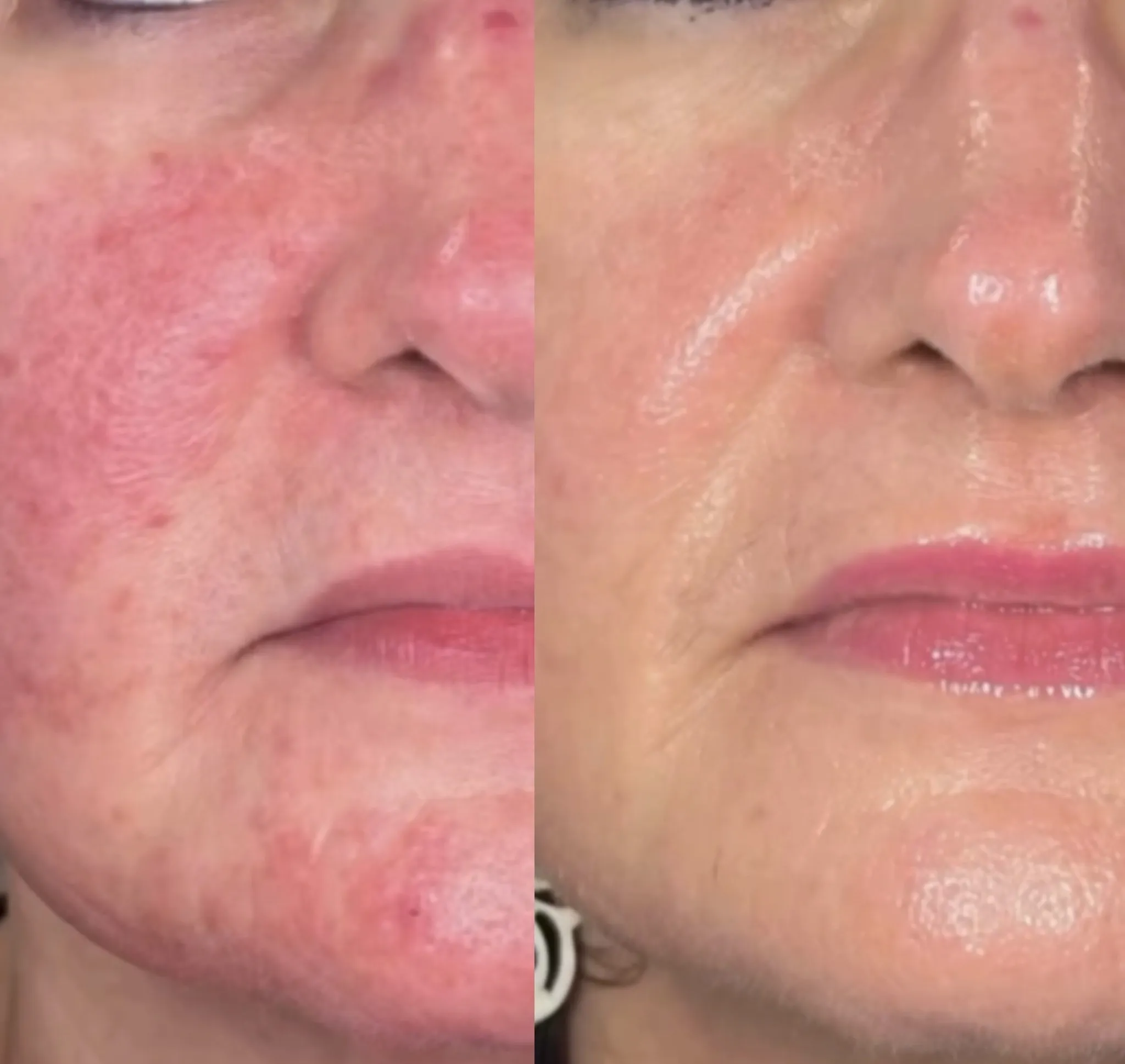 Efekt zabiegu przed i po