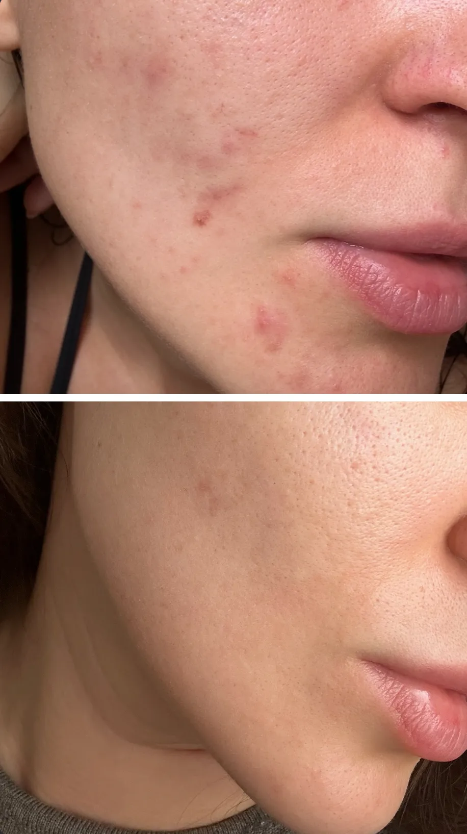 Efekt zabiegu przed i po